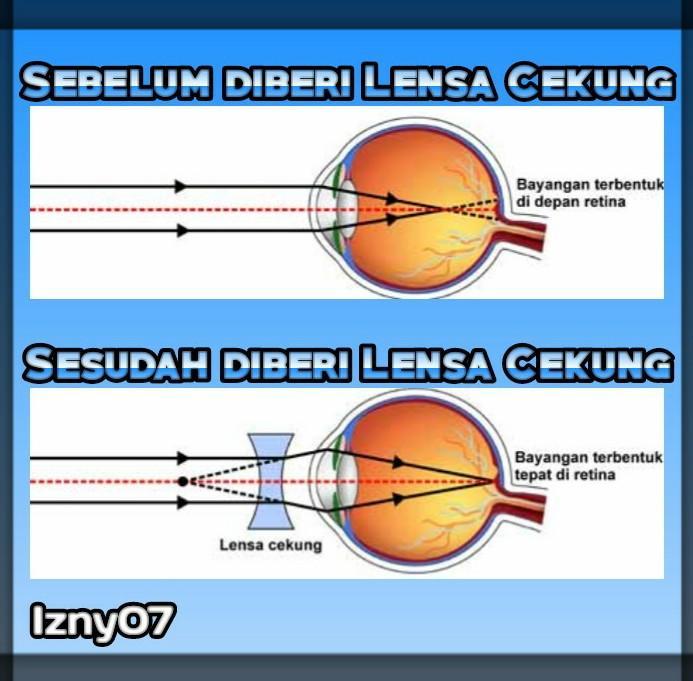 Detail Gambar Mata Hipermetropi Nomer 21