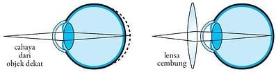 Detail Gambar Mata Hipermetropi Nomer 24