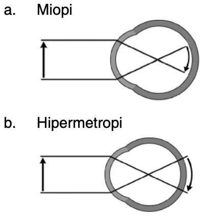 Detail Gambar Mata Hipermetropi Nomer 35