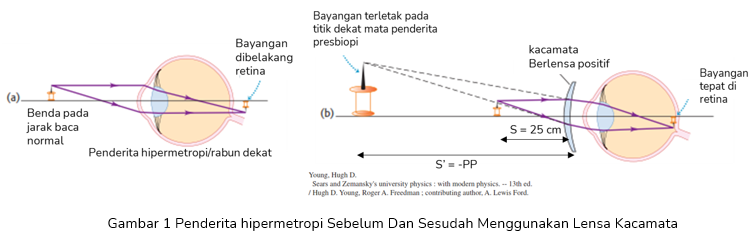 Detail Gambar Mata Hipermetropi Nomer 37