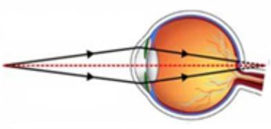 Detail Gambar Mata Hipermetropi Nomer 40