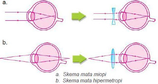 Detail Gambar Mata Hipermetropi Nomer 41