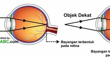 Detail Gambar Mata Hipermetropi Nomer 8