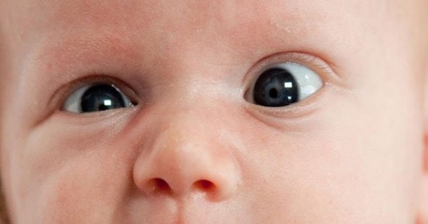Detail Gambar Mata Juling Pada Bayi Nomer 2