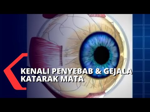 Detail Gambar Mata Katarak Nomer 40