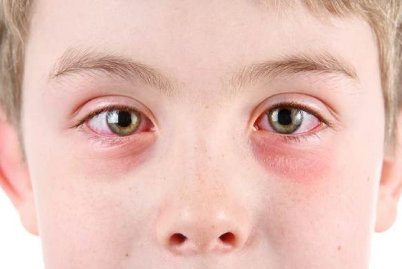 Detail Gambar Mata Merah Pada Anak Nomer 23