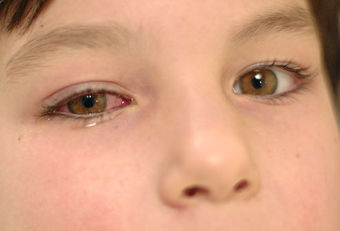 Detail Gambar Mata Merah Pada Anak Nomer 29