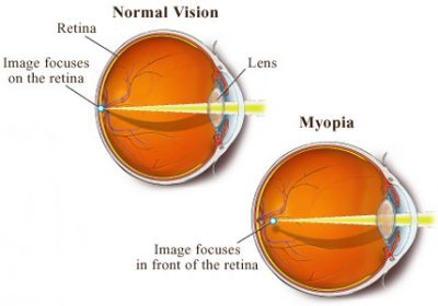 Detail Gambar Mata Minus Dan Normal Nomer 19