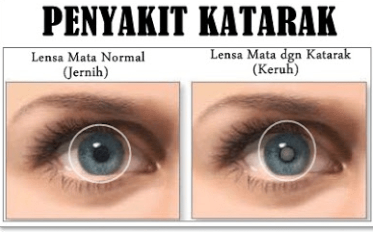 Detail Gambar Mata Normal Nomer 13