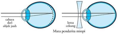 Detail Gambar Mata Normalrabun Jauhrabun Dekatmata Tuaastigmatisma Nomer 3