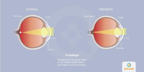 Detail Gambar Mata Presbiopi Nomer 2