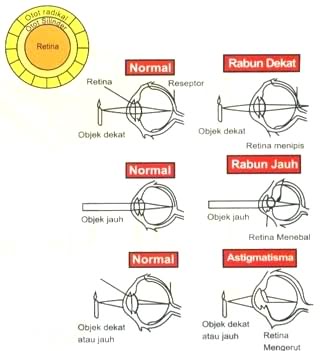 Detail Gambar Mata Presbiopi Nomer 26