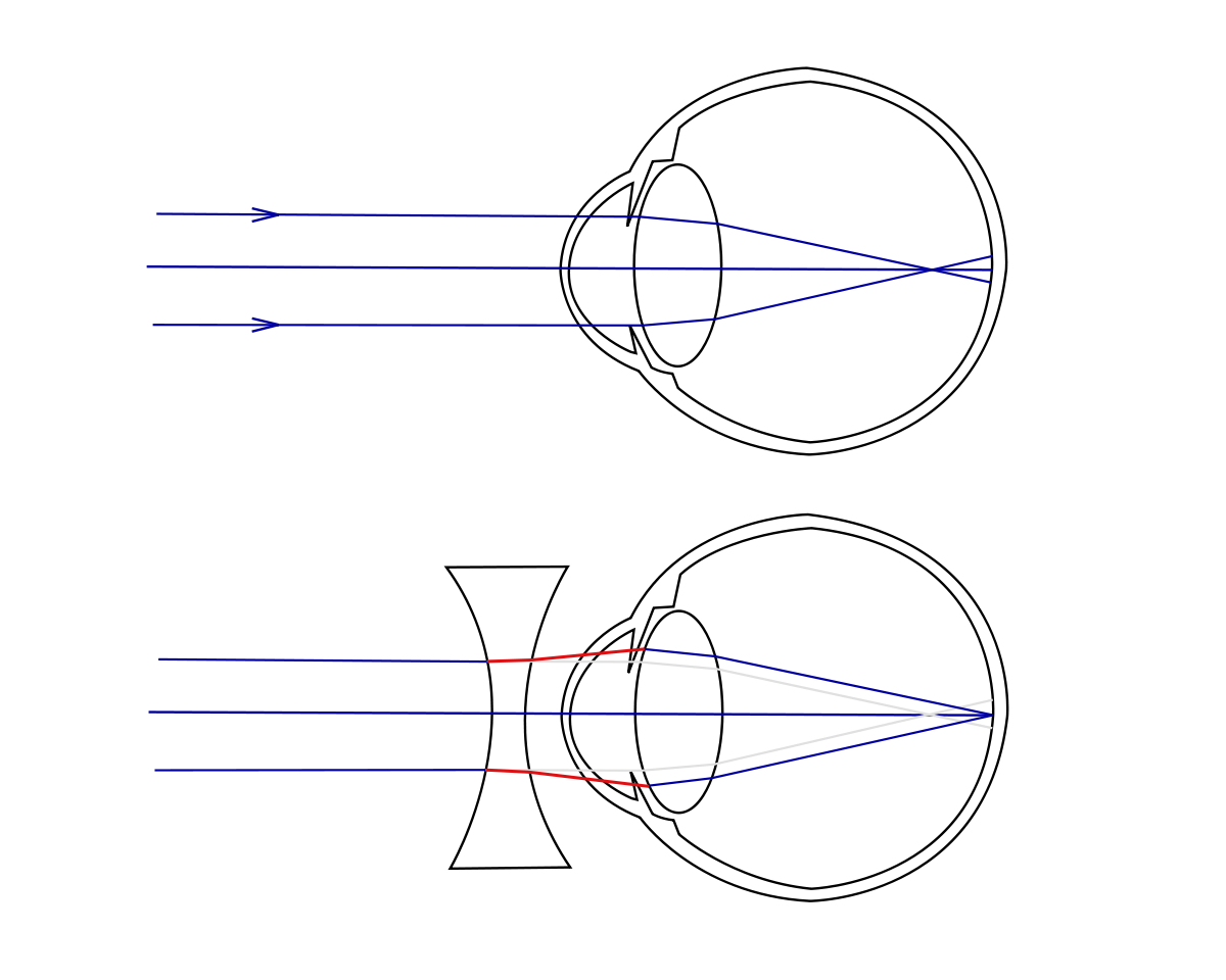 Detail Gambar Mata Rabun Jauh Nomer 25