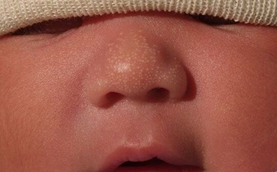 Detail Gambar Milia Pada Bayi Nomer 29