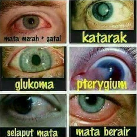 Detail Gambar Operasi Mata Katarak Nomer 50