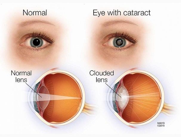 Detail Gambar Operasi Mata Katarak Nomer 54