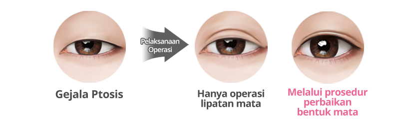 Detail Gambar Operasi Plastik Perbaikan Mata Nomer 8