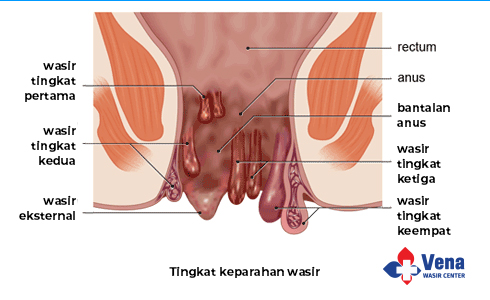 Detail Gambar Orang Ambeien Nomer 14