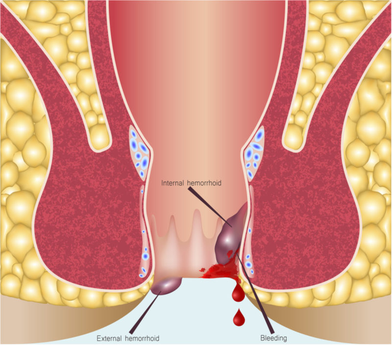 Detail Gambar Orang Ambeien Nomer 19