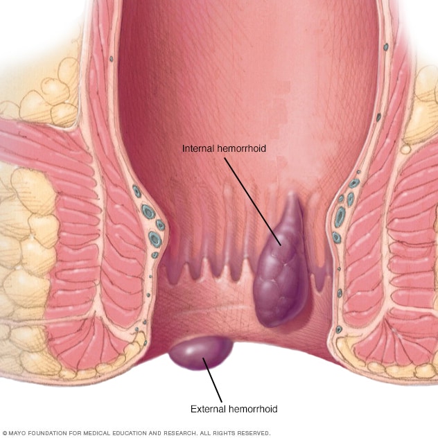 Detail Gambar Orang Ambeien Nomer 45