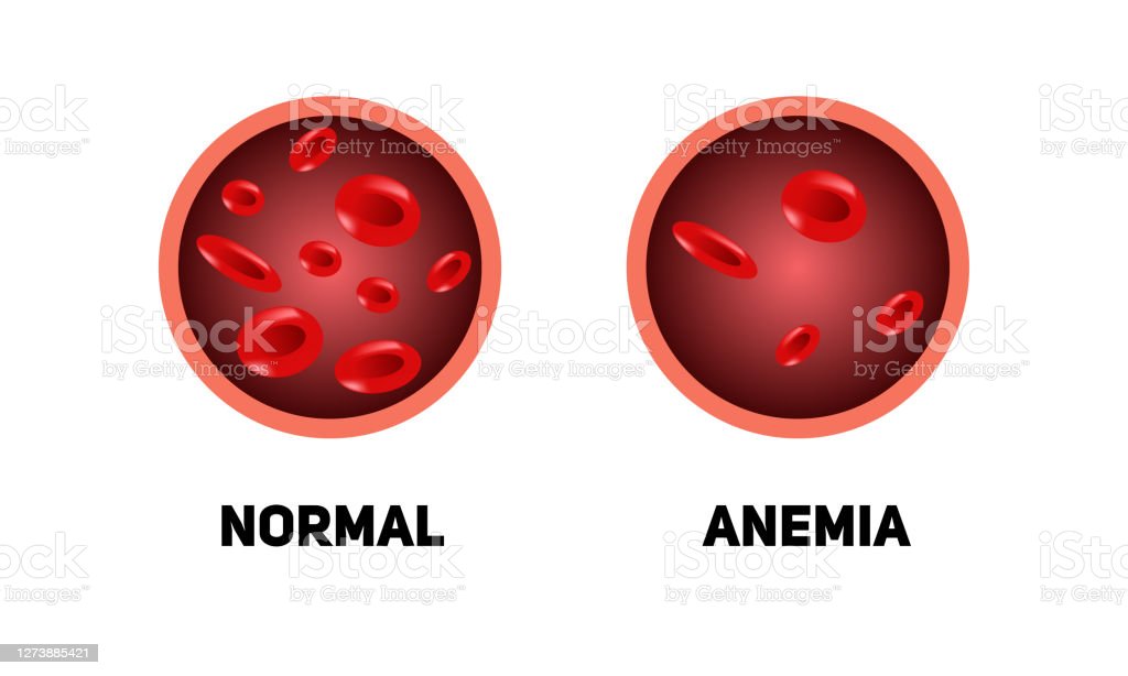 Detail Gambar Orang Anemia Nomer 50