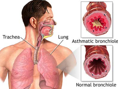 Detail Gambar Orang Asma Nomer 39