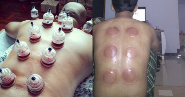 Gambar Orang Bekam - KibrisPDR
