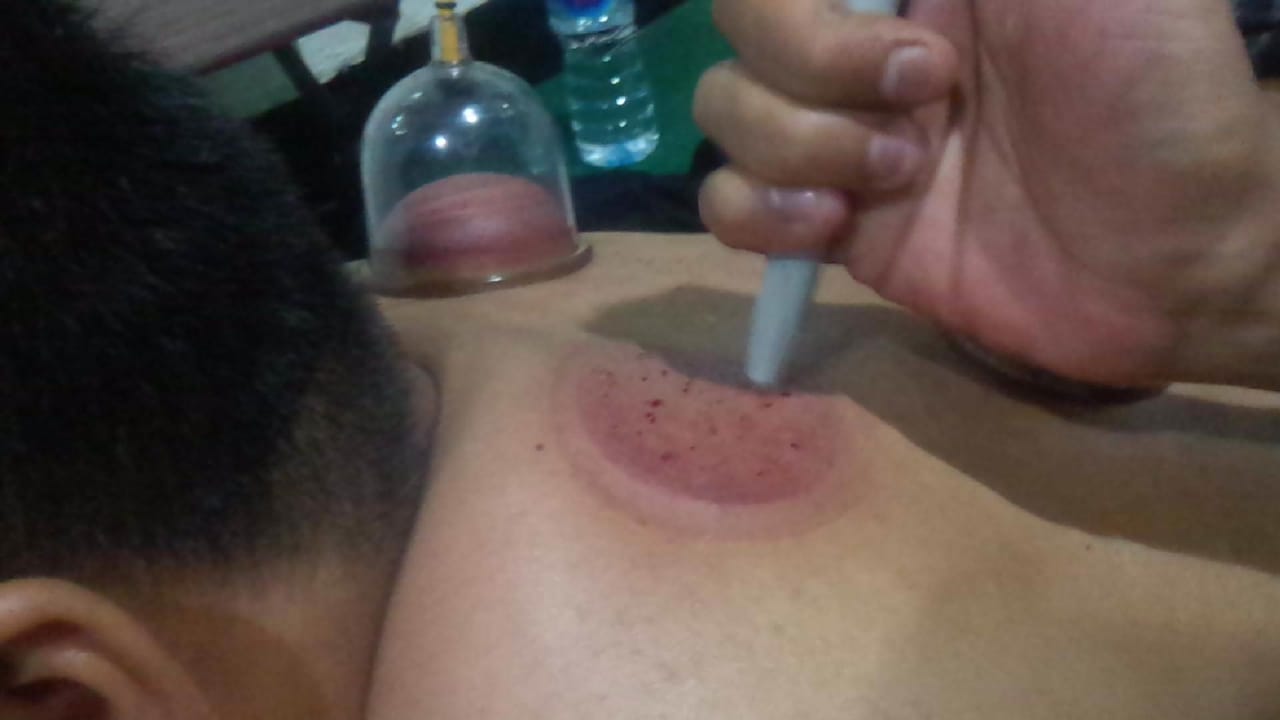 Detail Gambar Orang Bekam Nomer 13