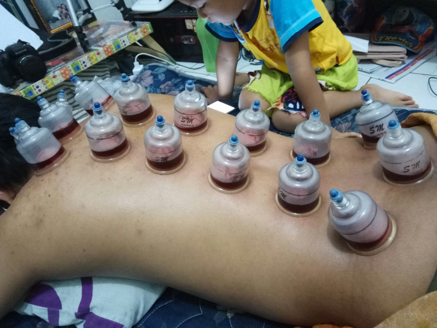 Detail Gambar Orang Bekam Nomer 26