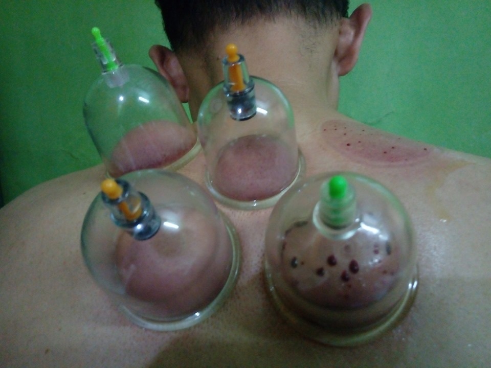 Detail Gambar Orang Bekam Nomer 29