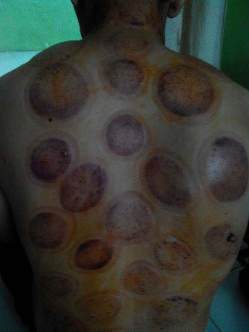 Detail Gambar Orang Bekam Nomer 32