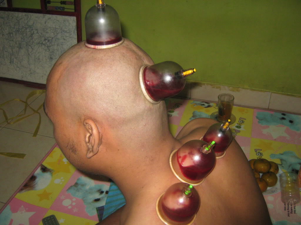 Detail Gambar Orang Bekam Nomer 48