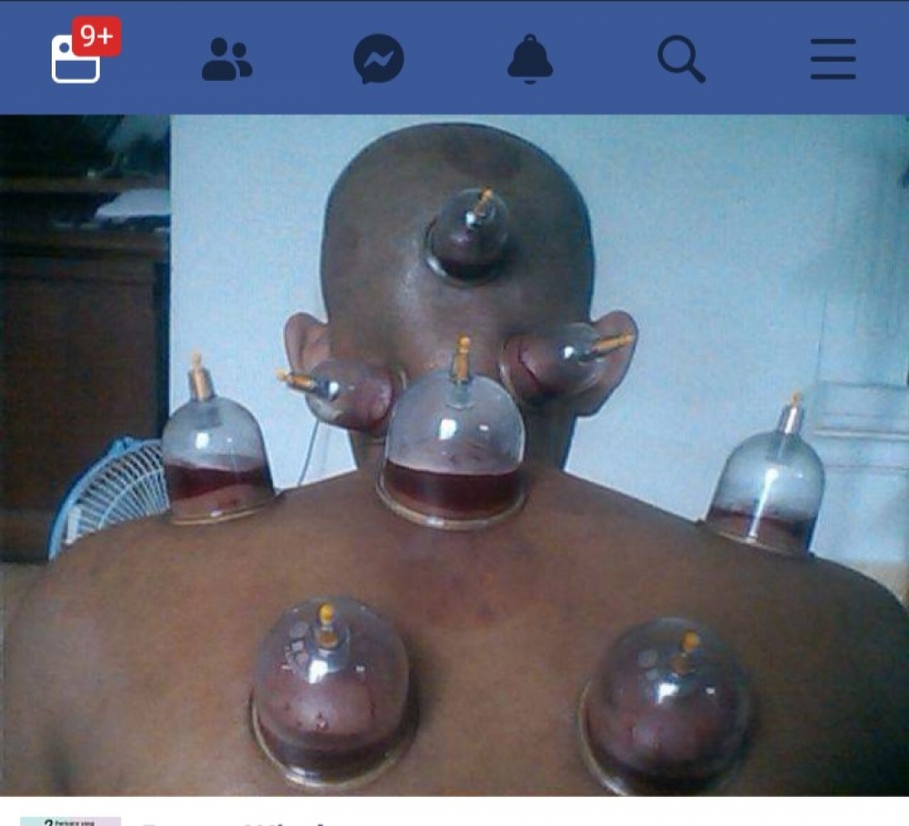 Detail Gambar Orang Bekam Nomer 50