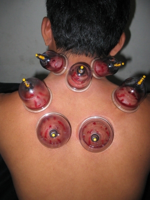 Detail Gambar Orang Bekam Nomer 7