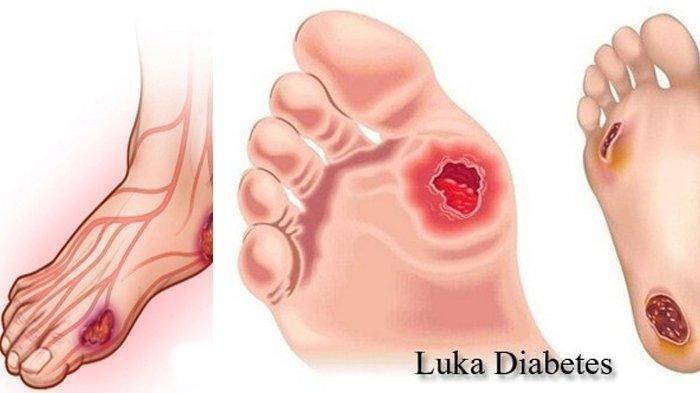 Detail Gambar Orang Diabetes Nomer 13