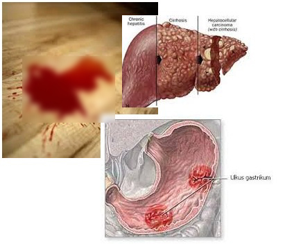 Detail Gambar Orang Muntah Darah Nomer 10