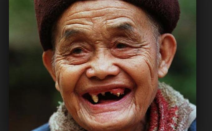 Gambar Orang Ompong - KibrisPDR