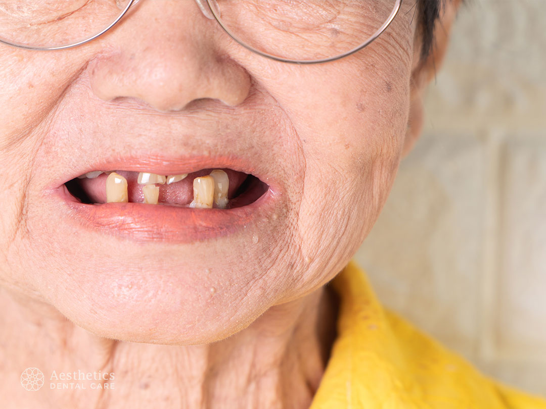 Detail Gambar Orang Ompong Nomer 10