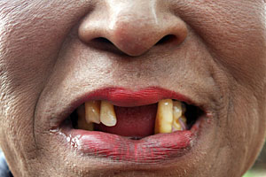 Detail Gambar Orang Ompong Nomer 25