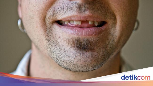 Detail Gambar Orang Ompong Nomer 41