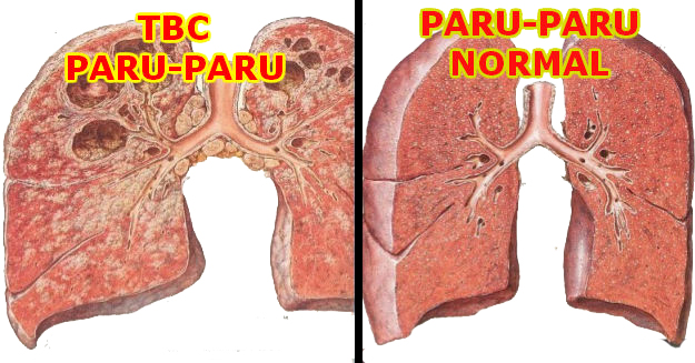 Detail Gambar Orang Penyakit Tbc Nomer 13