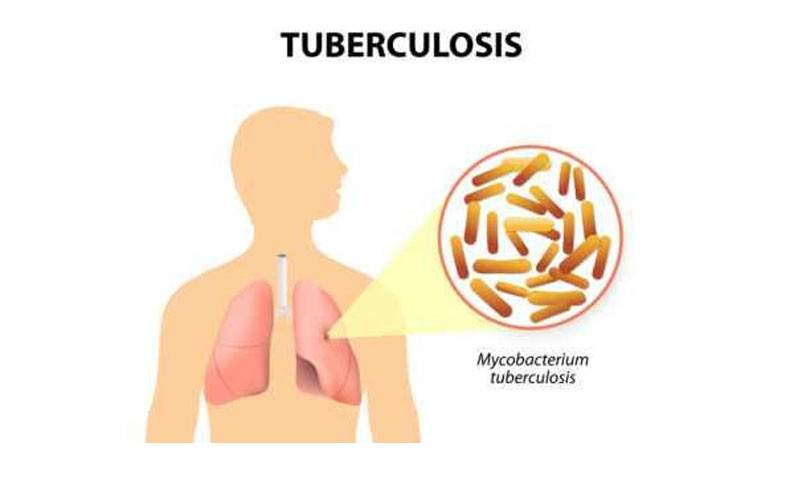 Detail Gambar Orang Penyakit Tbc Nomer 21