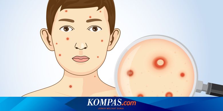 Detail Gambar Orang Sakit Hivaids Nomer 16