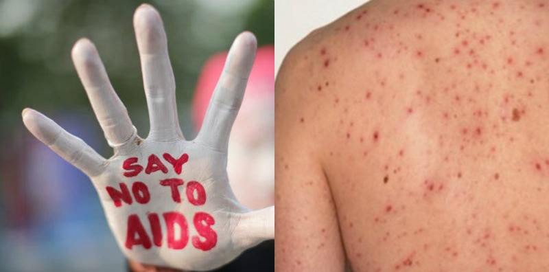 Detail Gambar Orang Sakit Hivaids Nomer 27