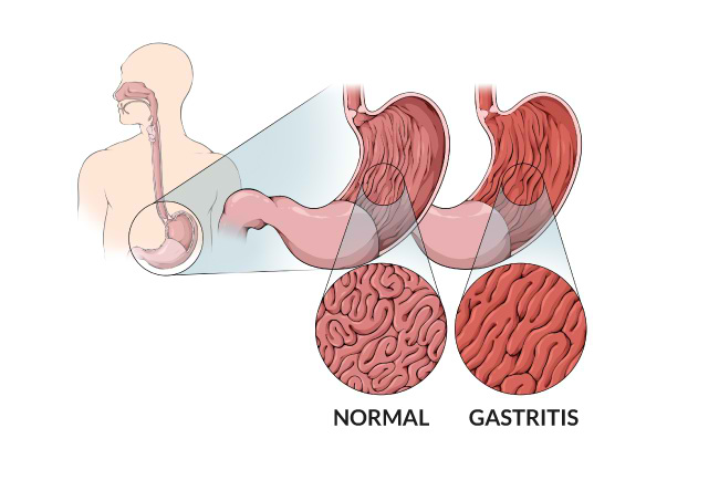 Detail Gambar Orang Terkena Gastritis Nomer 4