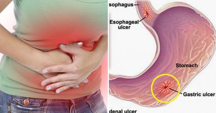 Detail Gambar Orang Terkena Gastritis Nomer 36