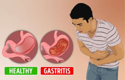Detail Gambar Orang Terkena Gastritis Nomer 5