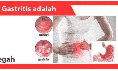 Detail Gambar Orang Terkena Gastritis Nomer 38