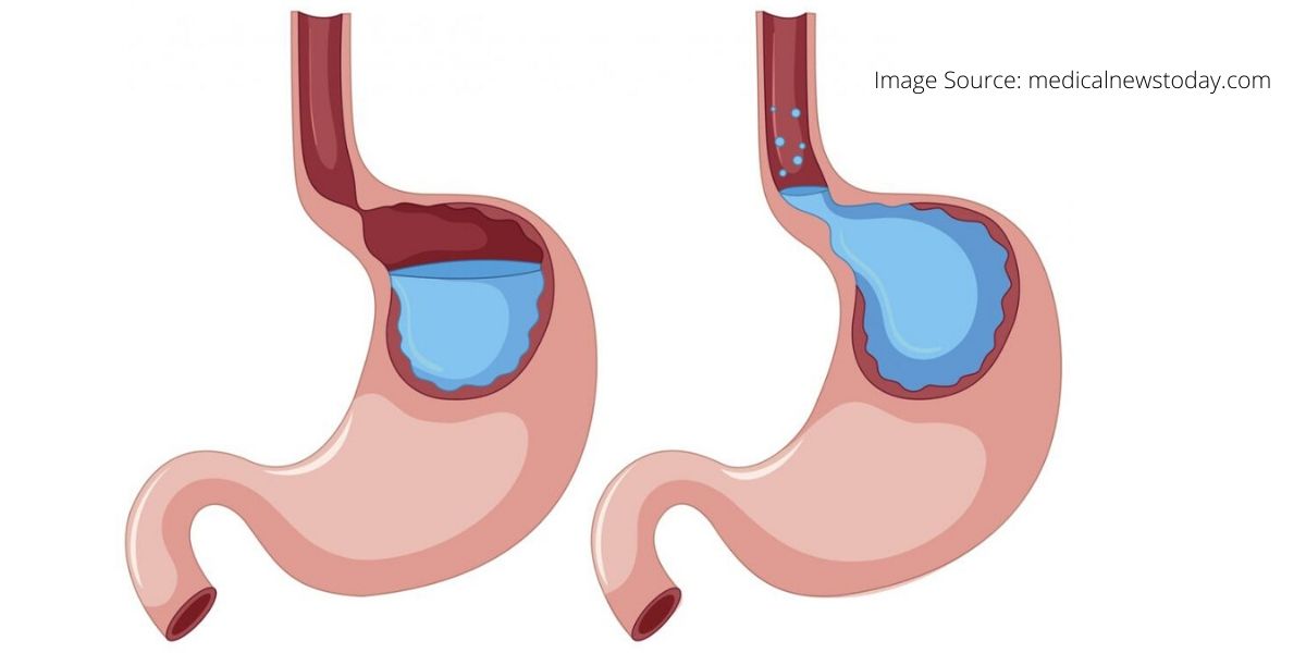 Detail Gambar Orang Terkena Gastritis Nomer 39