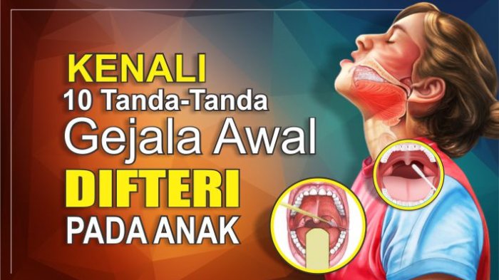 Detail Gambar Orang Yang Terkena Penyakit Difteri Nomer 19